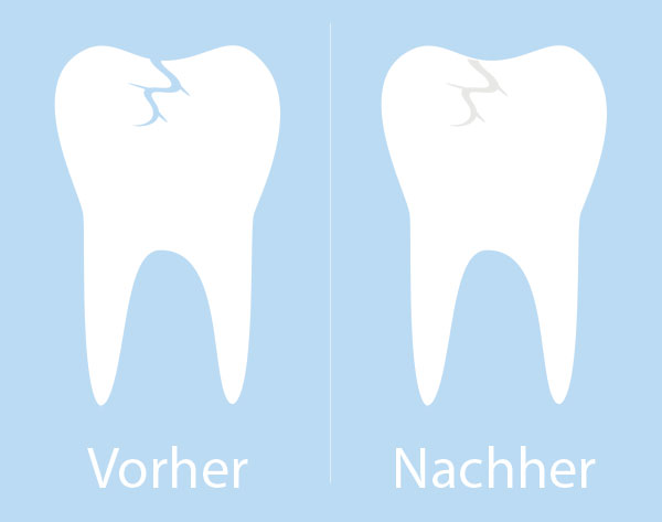 Die Fissurenversiegelung ist absolut schmerzfrei und wird an einem Zahn innerhalb weniger Minuten durchgeführt.