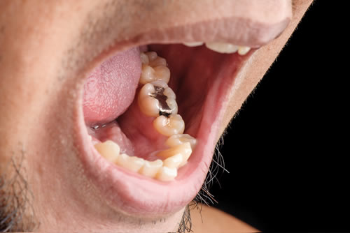 Amalgam